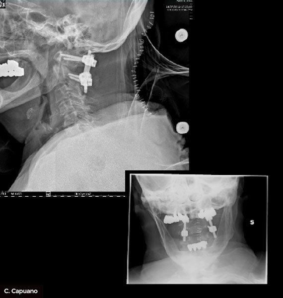 radiografia-postoperatoria